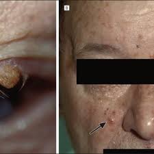 Sebaceous Adenomas On The Face In A Patient With Muir Torre Syndrome Download Scientific Diagram