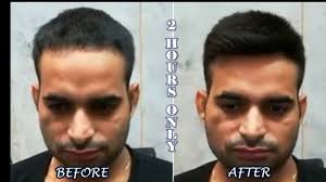 But the strands that are treated with the hair dye are affected in a few ways. Hair Patch Glue Vs Hair Patch Clipping Method Which One Is Better Planetofhaircloning Com