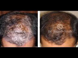 Yeast normally lives on the scalp and other hairy areas of the body, but the problem arises when there's too much yeast present, says dr. Pin On Stuff To Buy