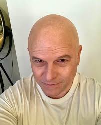 Is being bald an improvement or worse?