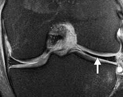 Mr Imaging Based Diagnosis And Classification Of Meniscal Tears Radiographics