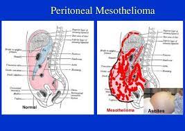 Aug 20, 2021 · peritoneal mesothelioma treatment options. Mesothelioma