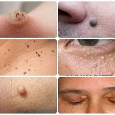 One day i googled buang tahi lalat melalui laser. Tahi Lalat Ketuat Kutil Biji Kolesterol Rev Posts Facebook