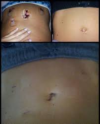 Pin By Hillary Duniven Biggerstaff On Health And Beauty Health And Beauty Ovarian Cyst Ovarian