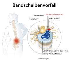 Bandscheibenvorfall Bandscheibe Operation Diskusprolaps