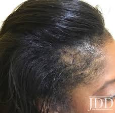 Depending on the desired level of coverage, toppers are. Frontal Fibrosing Alopecia Presenting As Androgenetic Alopecia In An African American Woman Next Steps In Dermatology