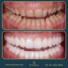 28 Zirconia Crowns Done By Our Doctor S Hands In 2021 Cosmetic Dentistry Dentistry Dental