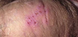 Image result for genital herpes