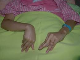 Image result for Tetany