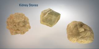 Like many other ailments, a poor diet is the leading cause of kidney stone formation. Your Kidney Stone My Kidney Stone Boston Scientific