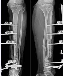 Image result for Osteomyelitis