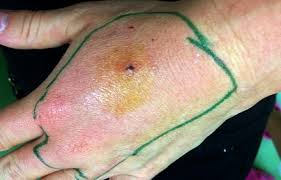 Do you know the causes, the risks, and what to do if you suspect what causes sepsis? Bis S Zum Septischen Schock Via Medici Klinik