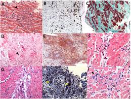 Image result for Myocarditis