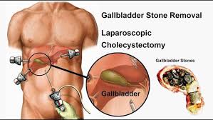 Unlike traditional alternative gallbladder flushes, where gall stones may often cause pain during their elimination many north americans will visit their doctor and receive only surgical treatment solutions. Which Is The Best Treatment For Gallbladder Stones Quora