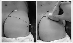 • acromion • clavicle • deltoid ( im. A Surface Landmarks The Line Between The Posterior Superior Iliac Download Scientific Diagram