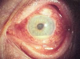 Image result for Uveitis