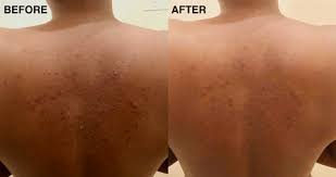 At the mild end, back acne can be treated with a benzoyl peroxide wash ( $15). How To Get Rid Of Bacne Best Products To Treat Back Acne