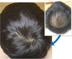 若ハゲ8年間に終止符 植毛150万と言われたハゲが 医学博士推奨の 緑色のフルーツ を頭に塗ったら 3ヶ月でガチでフサフサになった news monster 美容 医学 緑色