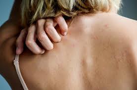 Symptoms are usually minimal, but mild to severe itching may occur. How Skin Conditions Can Affect Skin Cancer Detection And Treatment The Skin Cancer Foundation