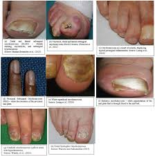 Image result for onychomycosis