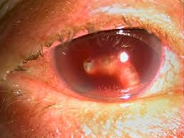 Image result for Hyphema