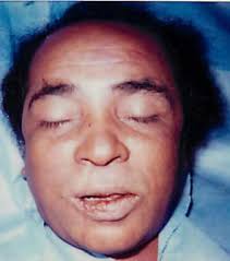 Bronx, New York Unidentified Black Male NamUs #UP8074 Date Found March 15,  1990 Estimated Age Group Adult