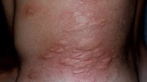 Image result for Cimex lectularius bites