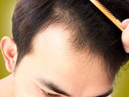 17+ rambut pria jidat lebar, inspirasi terkini! 8 Model Rambut Yang Cocok Untuk Kepala Botak Depan