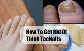 How To Get Rid Of Thick Toenails Thick Toenails Toe Nails Toenail Fungus