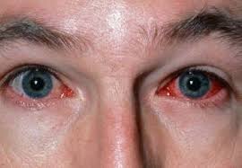 Maybe you would like to learn more about one of these? Viral Conjunctivitis Eye Disorders Merck Manuals Professional Edition