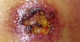 Image result for Spider Bite