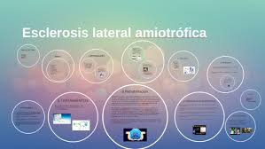Esclerosis lateral amiotrófica esclerosis lateral amiotróficaclasificación y recursos externos aviso médico. Esclerosis Lateral Amiotrofica By Joan Vidal Castello
