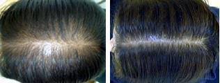 According to webmd, typically, each time a normal hair follicle is shed, it is replaced by hair that is equal in size. Celebrity Hair Loss Comparison Halle Berry