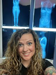 Living with Loey's Dietz syndrome and scoliosis