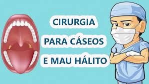 Cirurgia De Amigdalas Para Caseos Amigdalianos E Mau Halito
