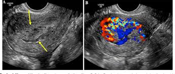 Ultrasound education specialist and clinical consultant charleston, south carolina. Figure 6 From Clinical And Imaging Predictors Of Management In Retained Products Of Conception Semantic Scholar