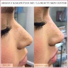 Non Surgical Rhinoplasty And Nose Jobs La Beauty Skin Center Rhinoplasty Nose Jobs Nonsurgical Nose Job Nose Fillers