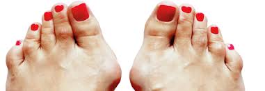Operiert wird dann, wenn die konservative therapie eines hallux valgus entweder nicht erfolgversprechend ist oder bereits erfolglos verlaufen ist. Symptomatischen Hallux Valgus Operieren Und Die Stockelschuhe Im Schrank Lassen Medical Tribune