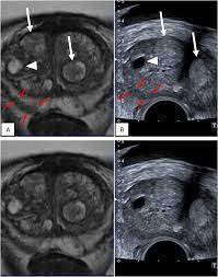 17.01.2020 · advanced prostate cancer can cause signs and symptoms including: Multiparametric Magnetic Resonance Imaging For The Detection Of Clinically Significant Prostate Cancer What Urologists Need To Know Part 3 Targeted Biopsy European Urology