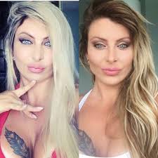 Em qualquer caso, você deve procurar um cirurgião plástico experiente para avaliar o caso e tratar com a melhor estratégia possível. Pensem Bem E Talvez Nao Facam Bichectomia Alfinetes De Morango