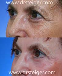 Maybe you would like to learn more about one of these? Fractional Co2 Laser Before And After Photos