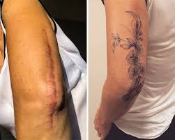 Birthmark Cover Up Tattoo Pin On Art