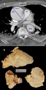 Image result for Cardiovascular Syphilis