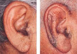Electrolysis is the actual process of removing hair using electricity. Ear Hair Function Ear Hair Removal Techniques