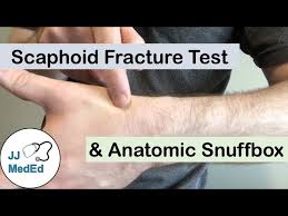 Image result for Scaphoid Fracture Signs