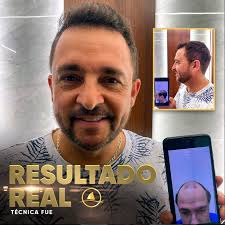 Harmony Transplante Capilar Santos