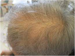 Which of the following nerve roots is most likely to be involved verapamil also affects cardiac contractility but has a minimal effect on skeletal muscle. Drug Reactions Affecting Hair And Nails Sciencedirect
