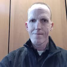 Abigail Soper developed hearing loss due to a rare autoimmune condition