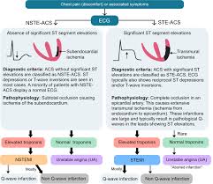 Image result for Myocardial Infarction Stabilization