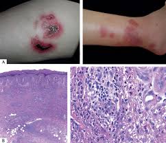 The defining clinical features of a mononucleosis syndrome are fever and reactive lymphocytes in the blood. Scielo Brasil Epstein Barr Virus And Skin Epstein Barr Virus And Skin